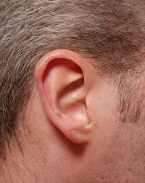 Epilation des oreilles